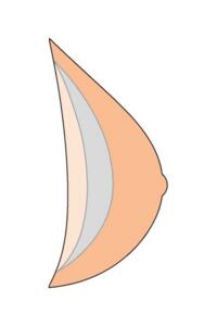 Natura Cosmetic 2SN Breast Form Alt 1
